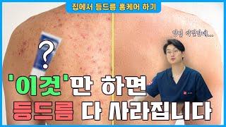 홈케어로 등드름 완벽하게 없애기