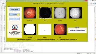 Diabetic Retinopathy Detection Using Image Processing Matlab Project Code