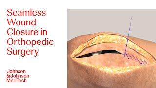 Effective Wound Closure Techniques in Orthopedic Surgeries Using DERMABOND | J&J MedTech