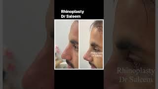 Rhinoplasty surgery in lahore by dr Saleem plastic surgeon.#rhinoplastypakistan #nosejob