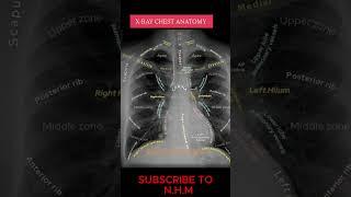 Chest xray diagnosis ||  Chest X-Ray Diagnosis Explained | Radiology Basics for Beginners.