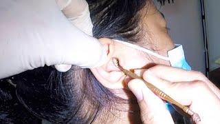 Removing Woman's HUGE Impacted Earwax