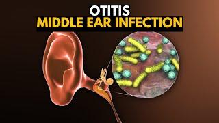 Middle Ear Infection (Otitis Media), Causes, SIgns and Symptoms, Diagnosis and Treatment.