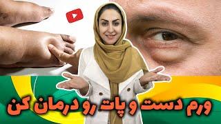 ورم دست و پات رو اینطوری درمان کن! | درمان ورم کل بدن، ورم دست، ورم پا، ورم زیر چشم و ...