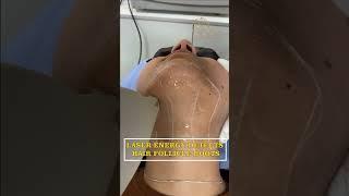 Laser Hair Removal Treatment in Zirakpur | The Skin Zeal | Dr. Isha V. Mittal | Call 72-93-93-93-26