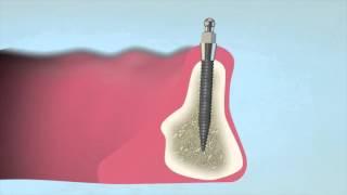 How to Place a 3M™ ESPE™ MDI Mini Dental Implant