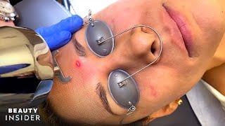 4 Treatments To Erase Acne Scars