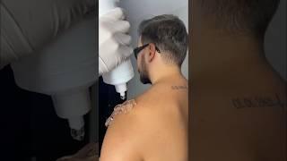 Laser hair reduction for Men ‍️#trending #skincare #drmanishachauhan #laserhairremoval #dermat
