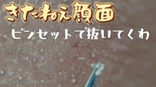 【汚顔】夏は角栓すげぇのよ。今回も眉間の角栓とったった