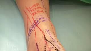 Neuromas y lipofilling