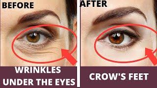 Eye Rejuvenation| Wrinkles Under the Eyes | Crow's feet | Eye Bags |Dark circles