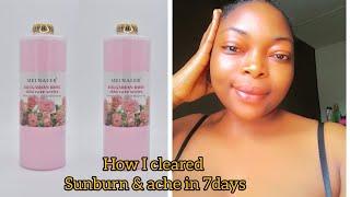 BULGARIAN ROSE WATER HOW I CLARED SUNBURN AND ACHES IN 7DAYS