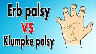 Erb's Palsy vs. Klumpke's Palsy