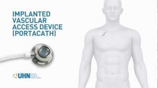 Port-a-Cath (Implanted Vascular Access Device)