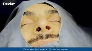 Ultrasonic rhinoplasty| Nosejob| Nose reshaping | rhinoplasty Pakistan | dr Amin Yousaf |