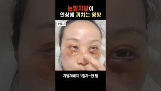 눈밑지방이 인상에 끼치는 영향 | 한달 후 #눈밑지 #눈밑지방재배치 #눈밑지방재배치후기 #지방재배치붓기 #눈밑지방재배치회복과정 #모즈클리닉