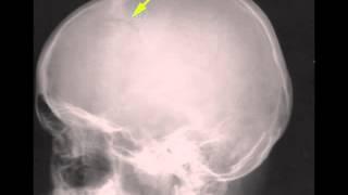 Depressed Skull Fracture on X ray