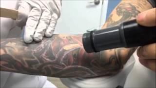 Detailed Laser Tattoo Removal Burke, VA, Northern VA, Fairfax County VA