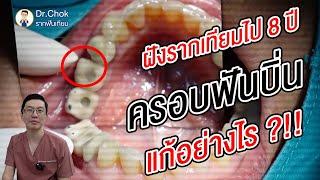 ฝังรากฟันเทียมไป 8 ปี จนครอบฟันบิ่น แก้อย่างไร คลิปนี้มีคำตอบ ?!!  | คลายปัญหารากฟันเทียมกับหมอโชค