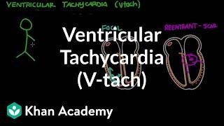 Ventricular tachycardia (Vtach) | Circulatory System and Disease | NCLEX-RN | Khan Academy