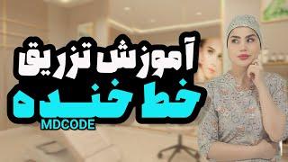 آموزش تزریق خط خنده به روش MDCODES.                  #بوتاکس #تزریق_ژل #خط_خنده