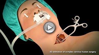 Cervical Fusion Surgery | Medical Animation