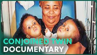 Twins Conjoined At The Heart Get Separated