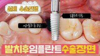 실제 어금니 발치 즉시 임플란트 식립 수술장면 및 수술과정