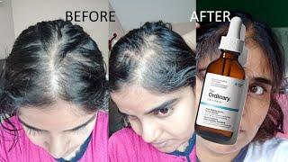 The Ordinary Hair Serum Review : Before & After - Multi-Peptide Serum For Hair Density