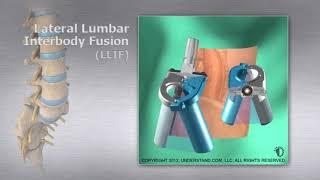 Lateral Lumbar Interbody Fusion LLIF