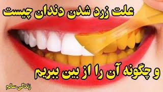 علت زرد شدن دندان چیست:وچگونه آن را ازبین ببریم؟