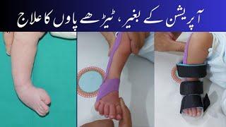 Club foot physiotherapy treatment | Exercises,Taping,Splint ٹیڑھے پاوں کا علاج #stretching #physio