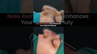 Nose Reshaping That Enhances Your Natural Beauty #nosejob #rhinoplasty #beautytips