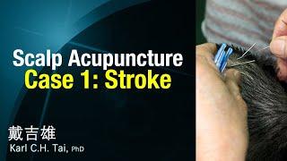 Tai's Scalp Acupuncture - Case 1: Stroke