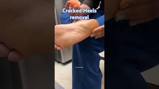Cracked Heels removal #shorts #feet #riyadreampath #diy