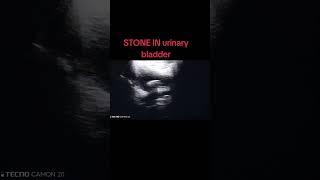 Stone in Urinary Bladder.