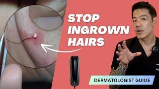 Stop Shaving and No More Ingrowns | IPL Laser Hair Removal at Home | Dr Davin Lim