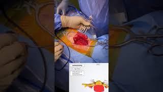 What is Posterior Cervical Decompression Surgery? 