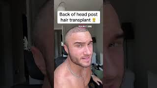 2500 grafts - Manual hair loss treatments on profile