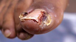 Ever Seen a JUICY INFECTED INGROWN TOENAIL Before???