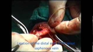 Ligation and stripping of varicose veins - surgical anatomy