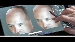 Hair By Dr. Max, Restoration Center - ARTAS Hair Transplant Results