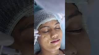 Hydra facial Treatment For Glowing Skin | हाइड्रा फेश‍ियल Step by Step | Skinaa Clinic #shorts