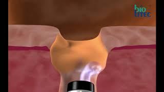 biolitec® - XCAVATOR® and TWISTER - smooth and gentle Prostate Vaporization - Animation