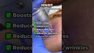 Microneedling radiofrequency | Microneedling combined with radiofrequency | Mnrf | Scar treatment