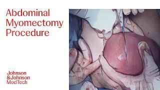 Abdominal Myomectomy Surgery to Remove Fibroids with Dr. Steven McCarus | J&J MedTech