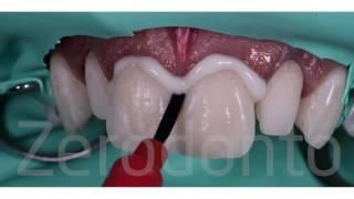 Dental Veneers