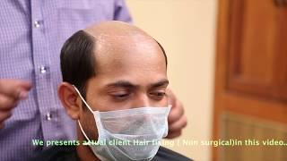 Modern Hair Fixing and Replacement in Bangalore 9951223066