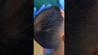 Beratung zur Haartransplantation in Deutschland | Minh's Erfahrung