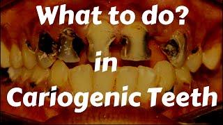 What To Do In Cariogenic Teeth? Dental Caries Treatment || Stop Dental Caries? Best Filling Material